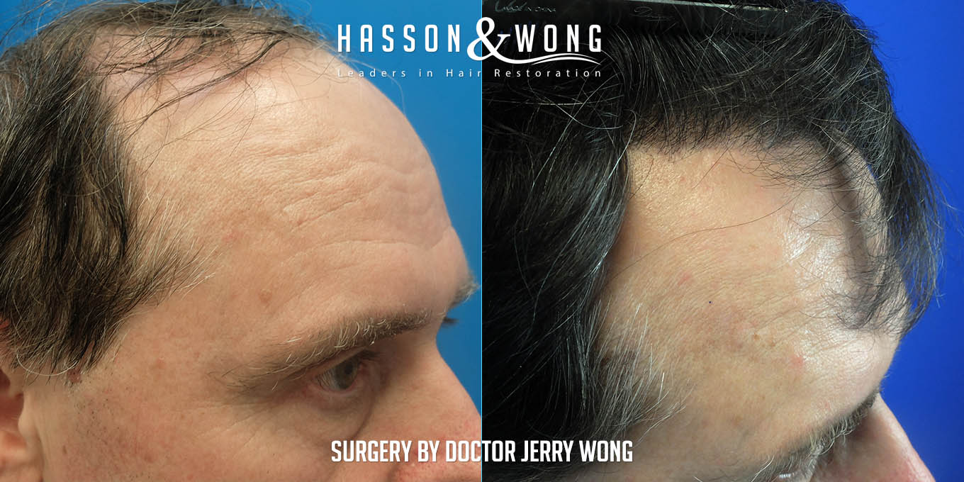 js-drw-fut-hair-transplant-6301-grafts-right-close-before-after.jpg