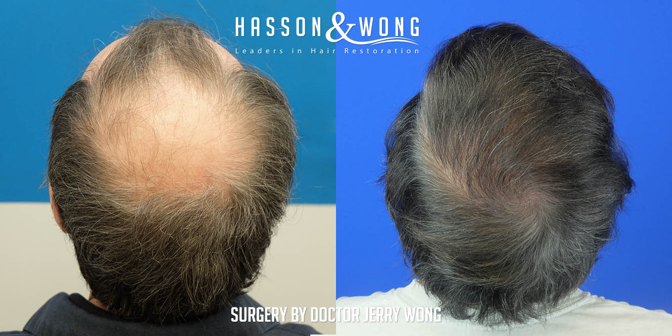 js-drw-fut-hair-transplant-6301-grafts-tilt-back-before-after.jpg
