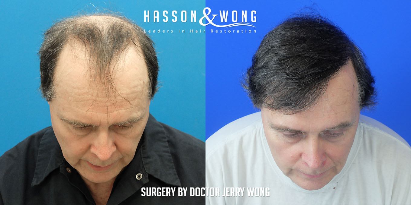 js-drw-fut-hair-transplant-6301-grafts-tilt-before-after.jpg