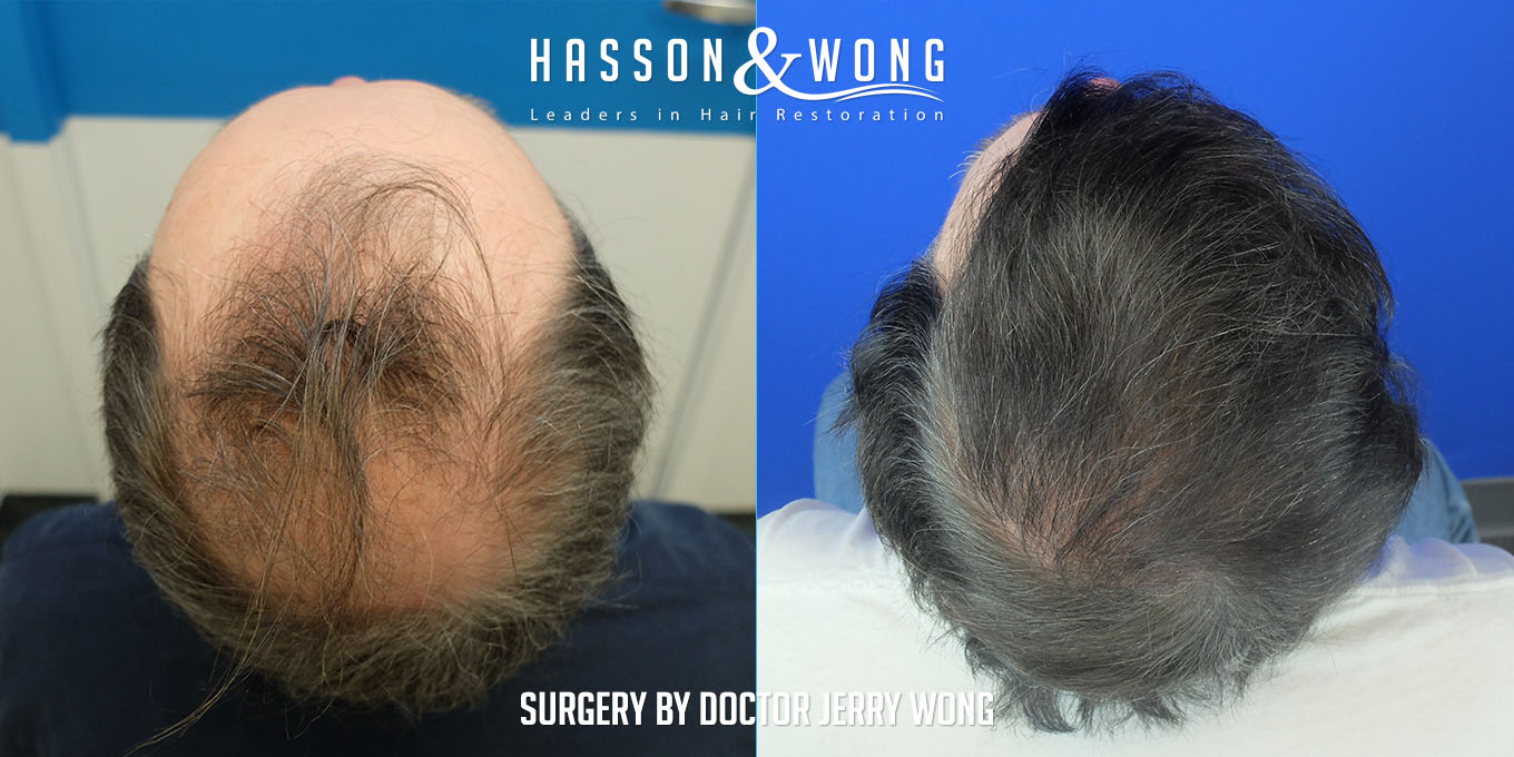 js-drw-fut-hair-transplant-6301-grafts-top-back-before-after.jpg