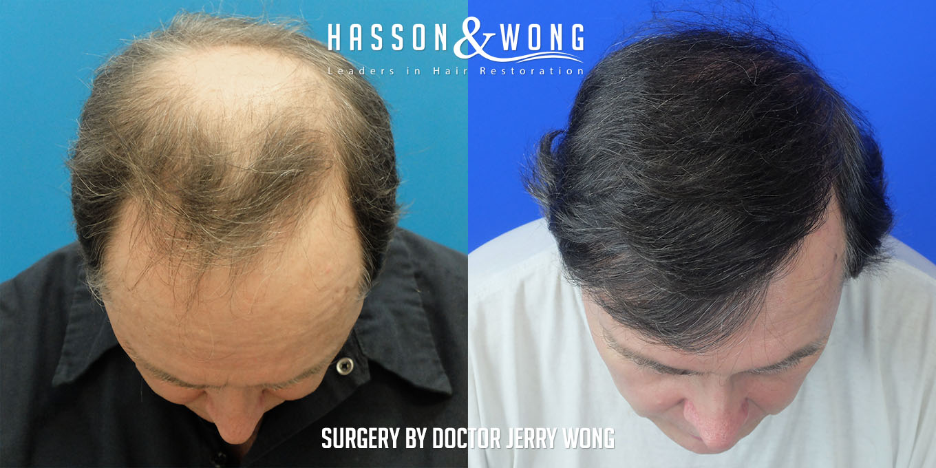 js-drw-fut-hair-transplant-6301-grafts-top-before-after.jpg