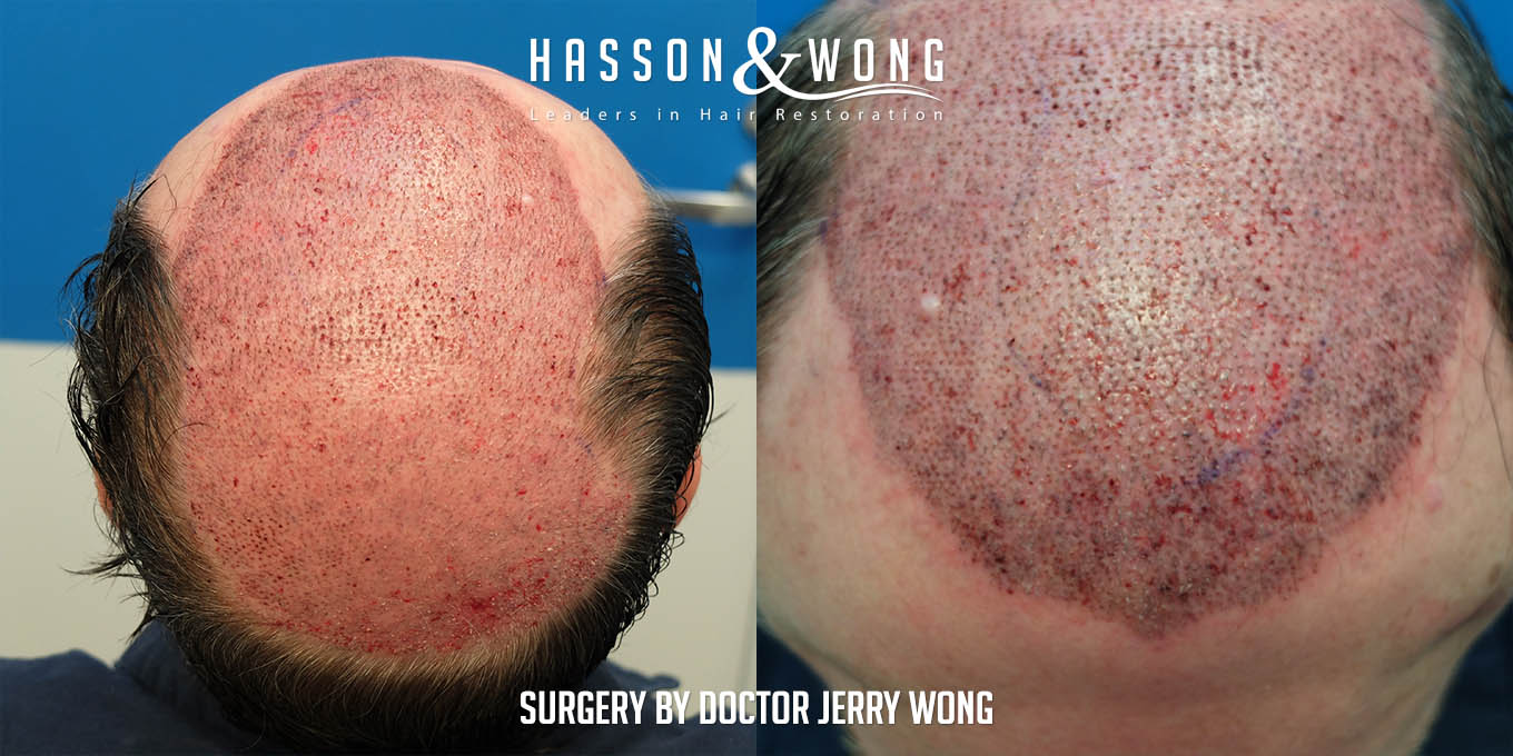 js-drw-fut-hair-transplant-6301-grafts-transplant-area-before-after.jpg