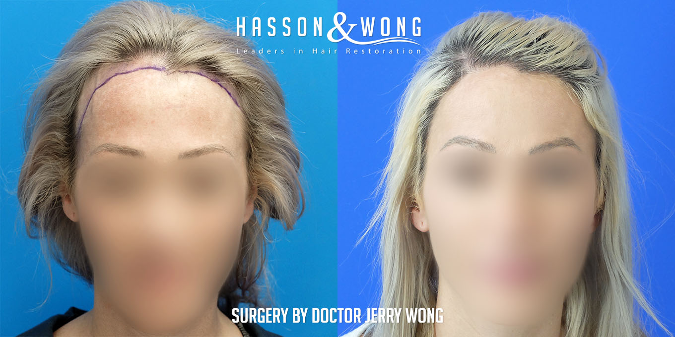 hair-restoration-surgery-before-after-13