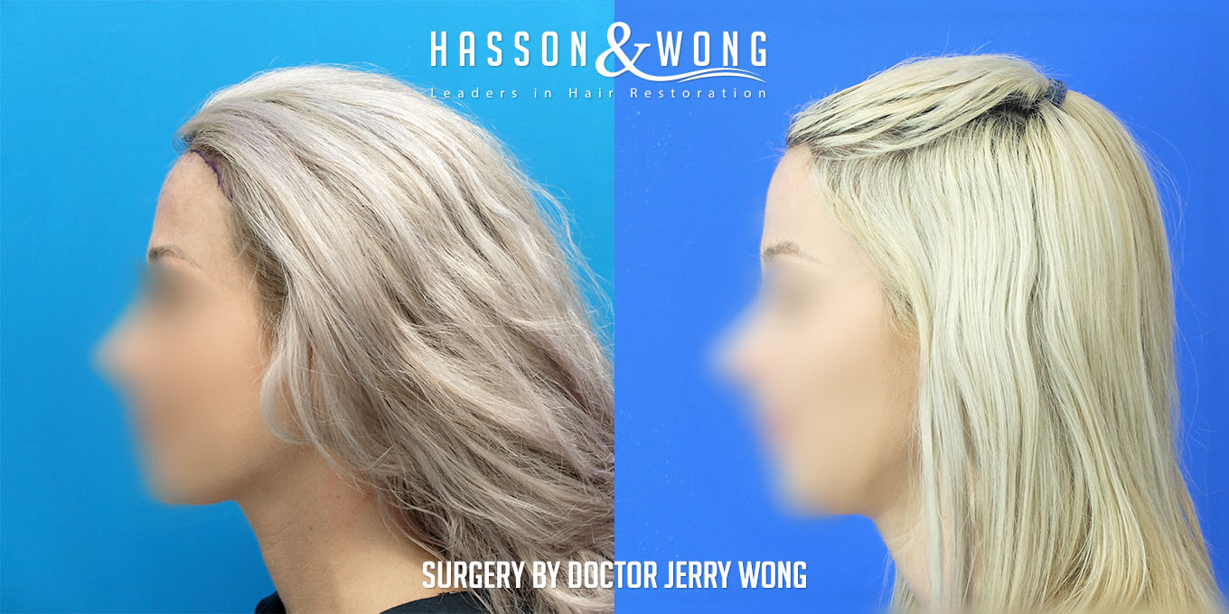 hair-transplant-surgery-before-after-137