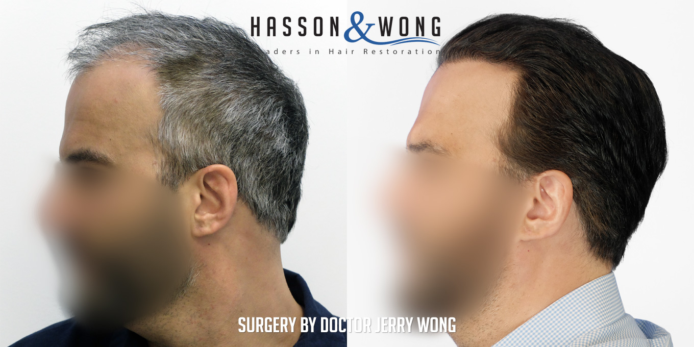 hair-restoration-surgery-before-after-44