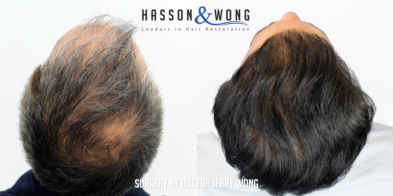 hair-restoration-surgery-before-after-44
