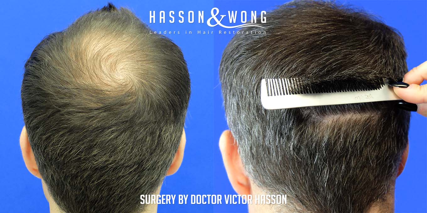 hair-transplant-surgery-after-4699-graft