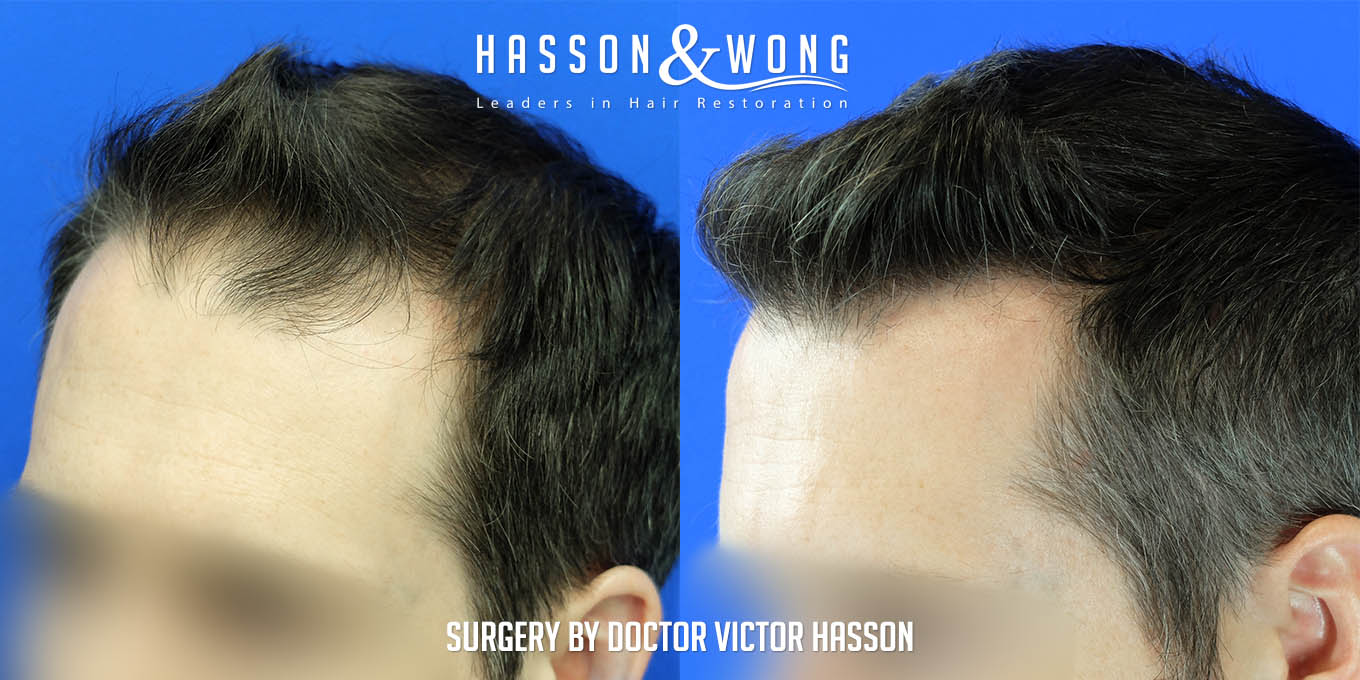 hair-transplant-surgery-after-4699-graft