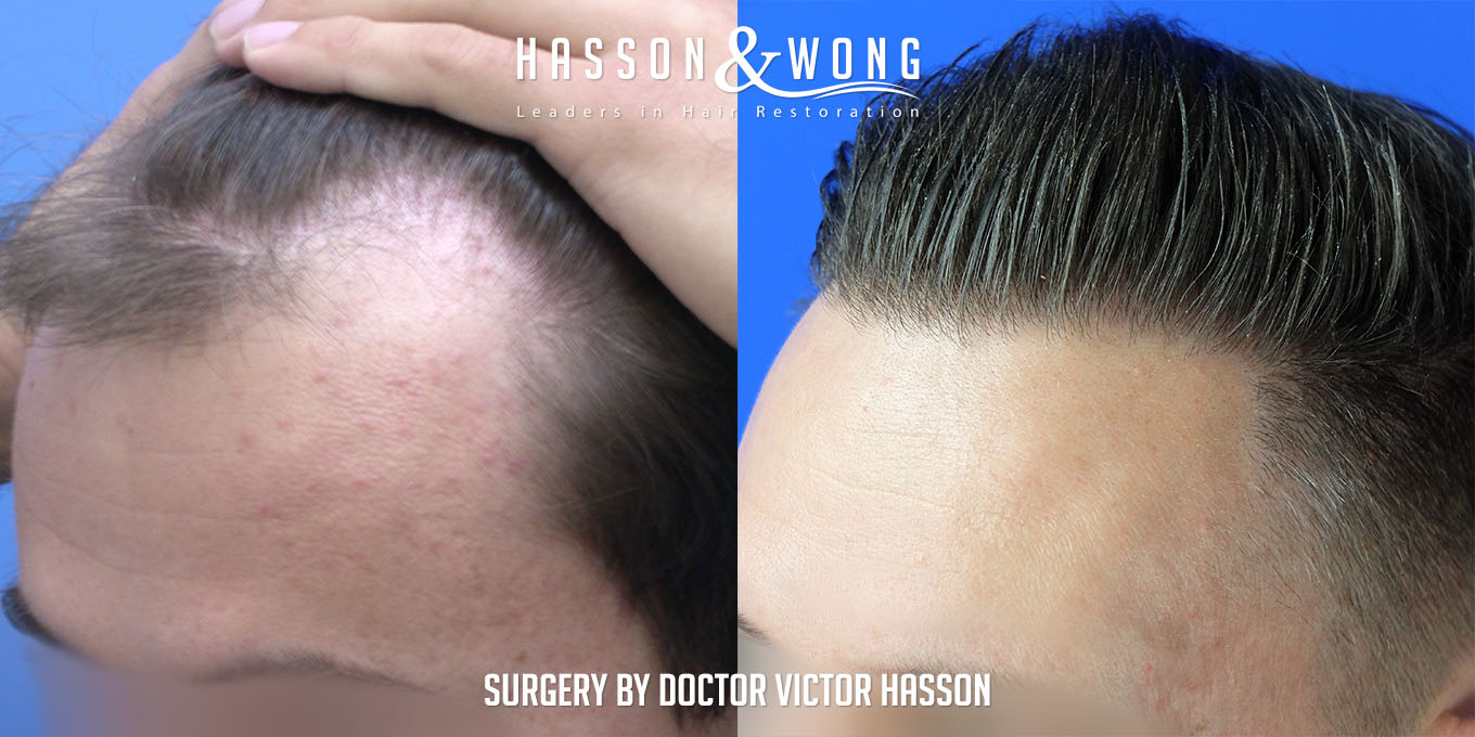 hair-restoration-before-after-4260-graft