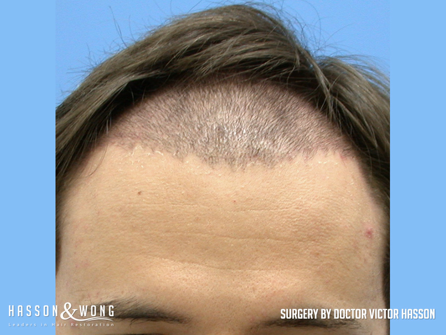 hair-restoration-surgery-after-312-graft
