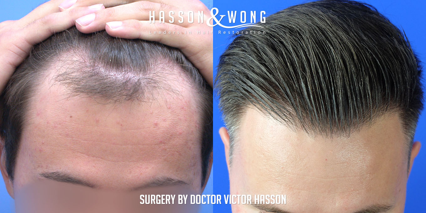 hair-transplant-before-after-4260-grafts