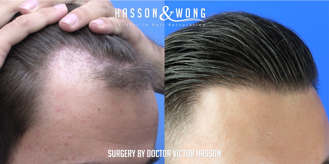 hair-transplant-surgery-before-after-426