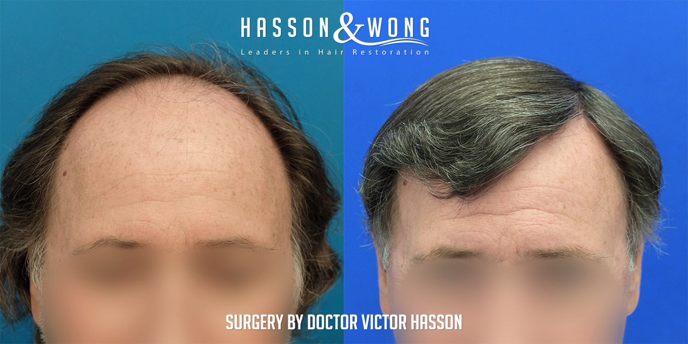 hair-restoration-before-after-4200-graft