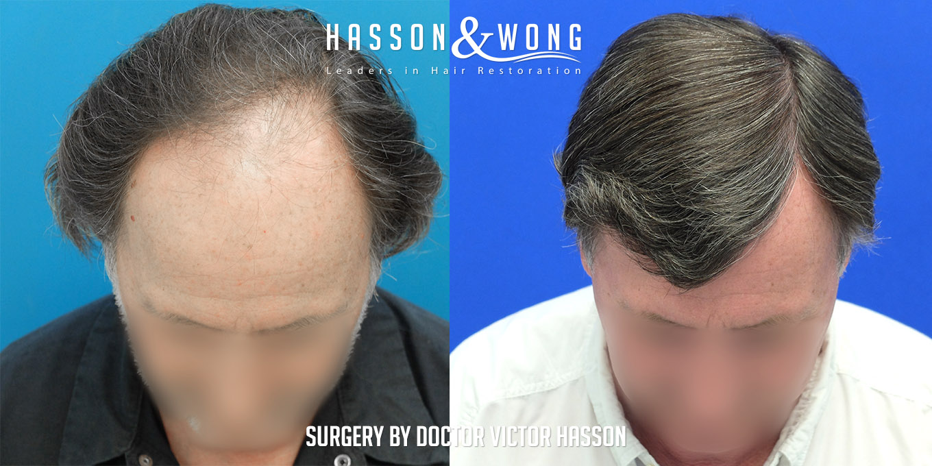 hair-transplant-before-after-4200-grafts