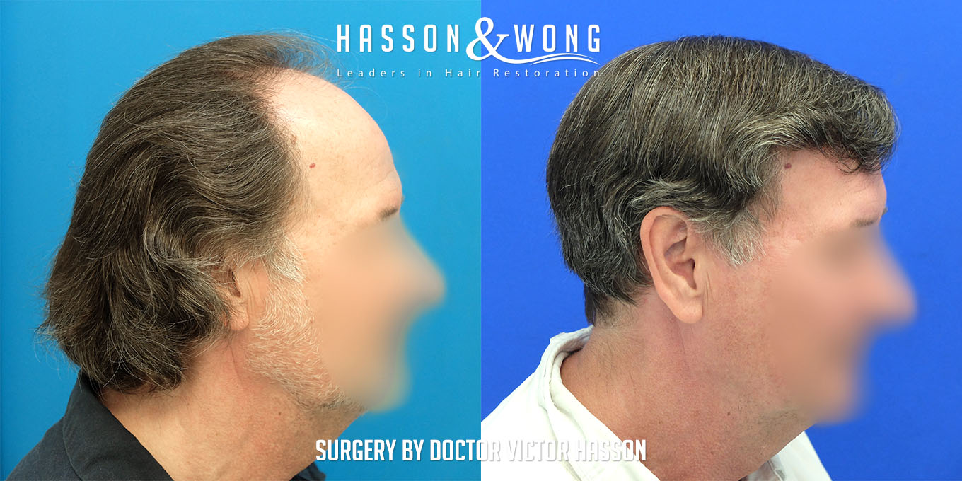 hair-transplant-surgery-before-after-420
