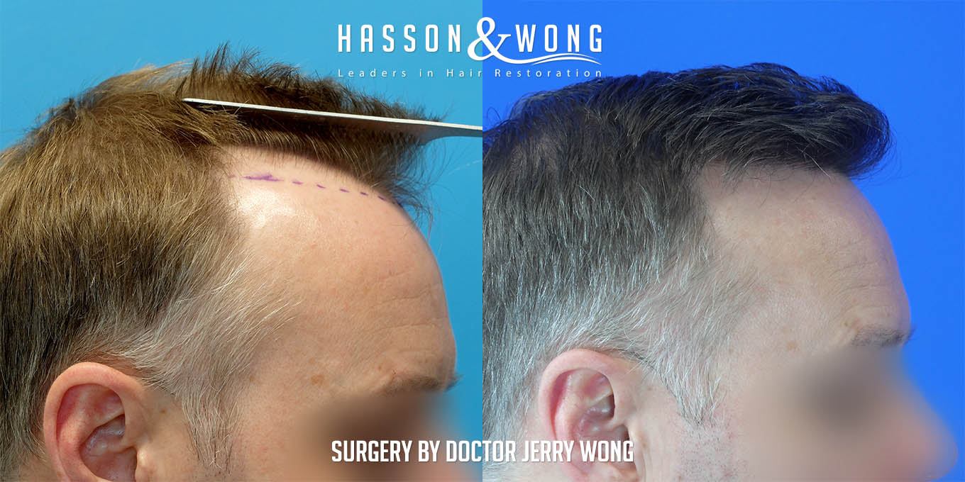 hair-restoration-surgery-before-after-42