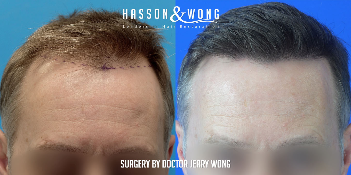 hair-transplant-before-after-4287-grafts