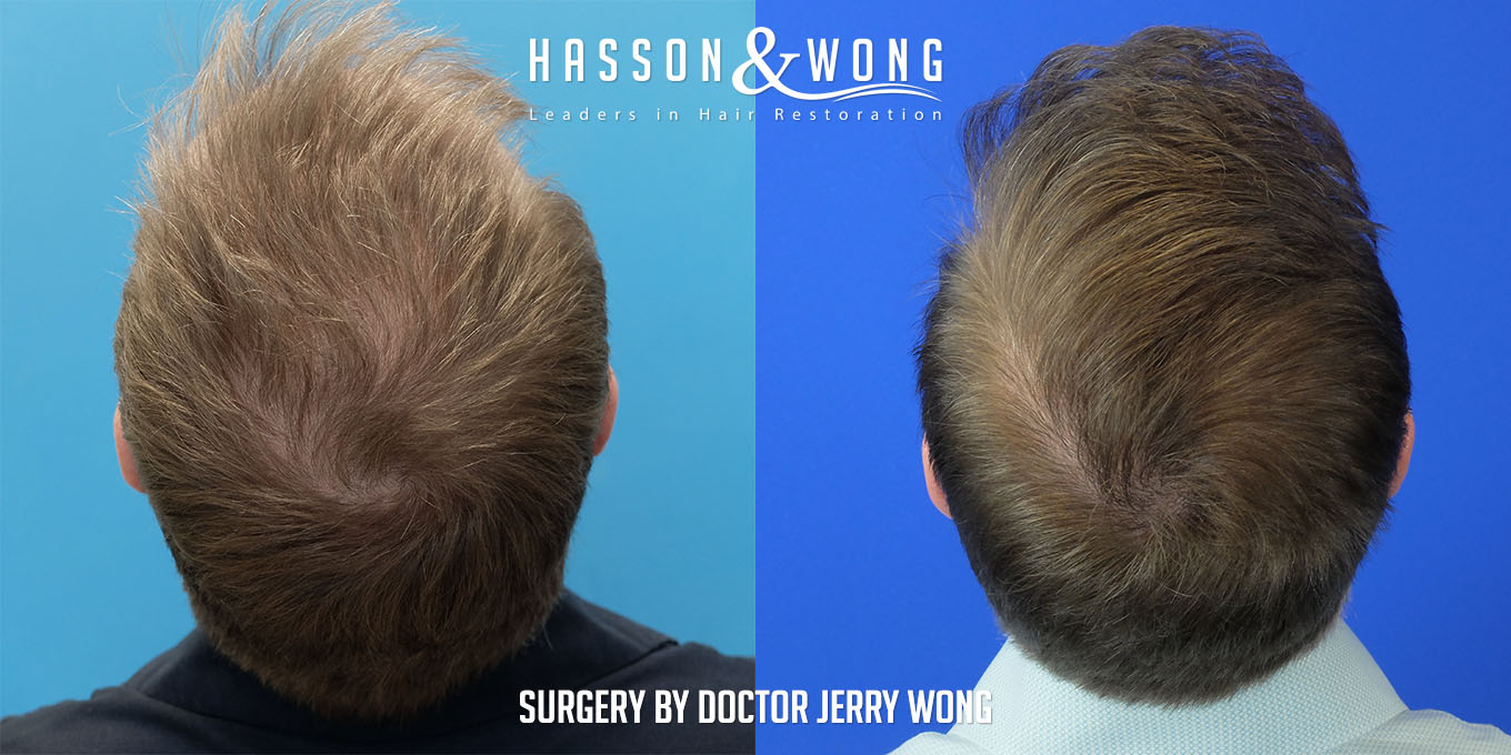 hair-transplant-surgery-before-after-428