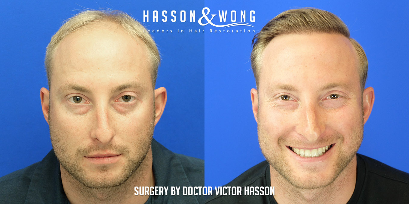 hair-restoration-surgery-before-after-42
