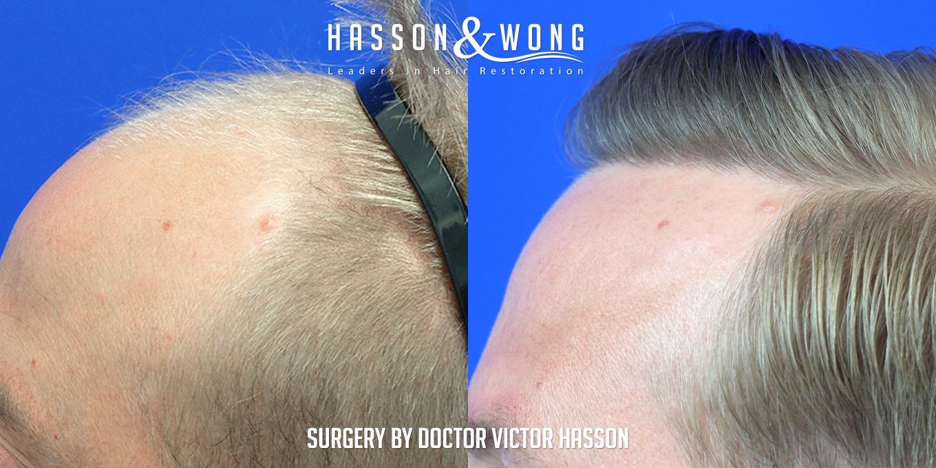 hair-transplant-surgery-before-after-421