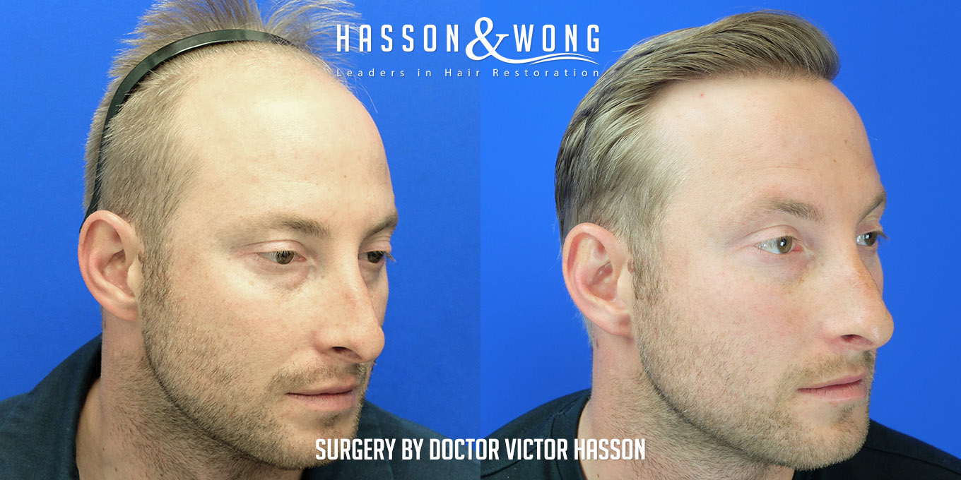 hair-transplant-surgery-before-after-421