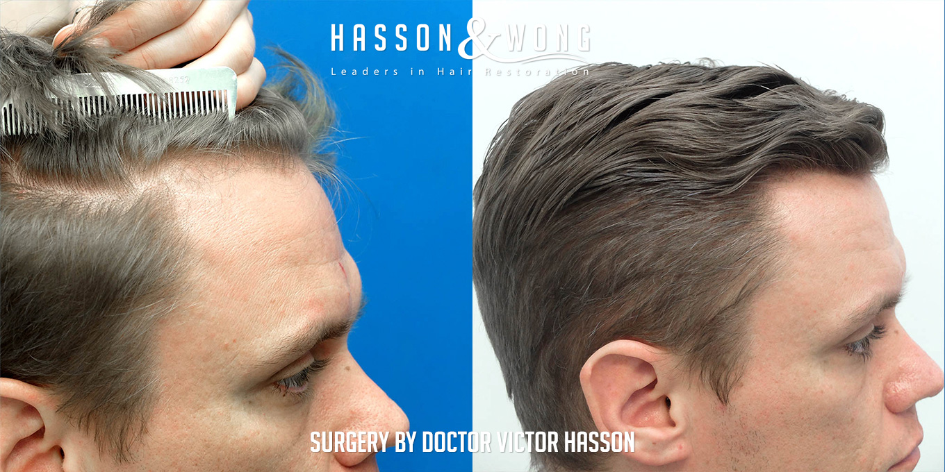 sk-drh-1310-fue-before-after-right-profile.jpg