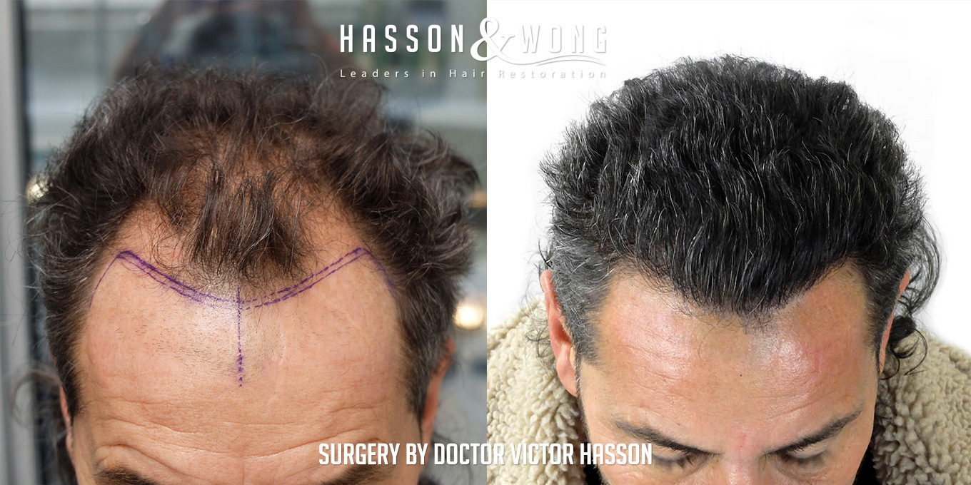 sl-drh-fut-hair-transplant-4656-grafts-front-close-before-after.jpg