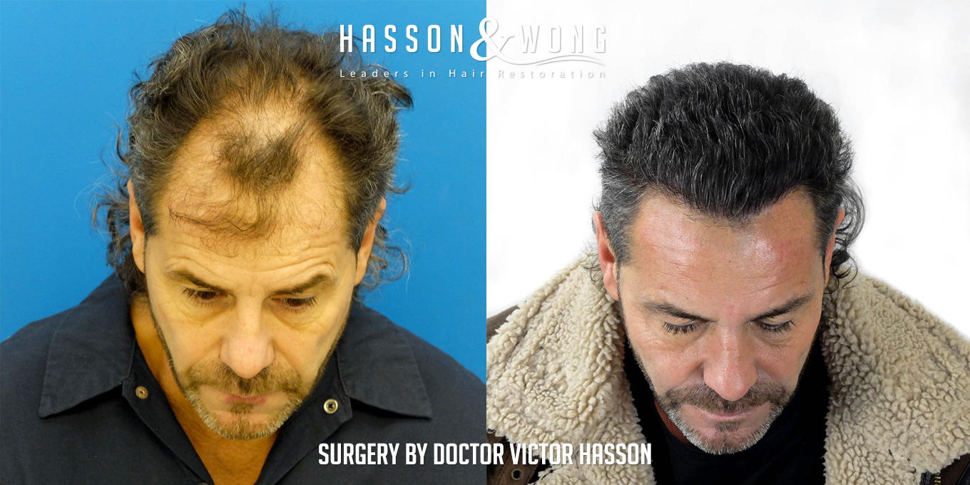 sl-drh-fut-hair-transplant-4656-grafts-front-tilt-before-after.jpg