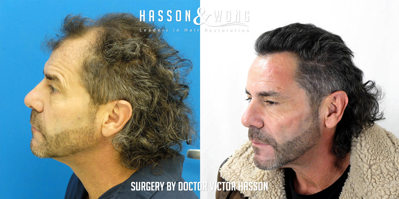 sl-drh-fut-hair-transplant-4656-grafts-left-before-after.jpg