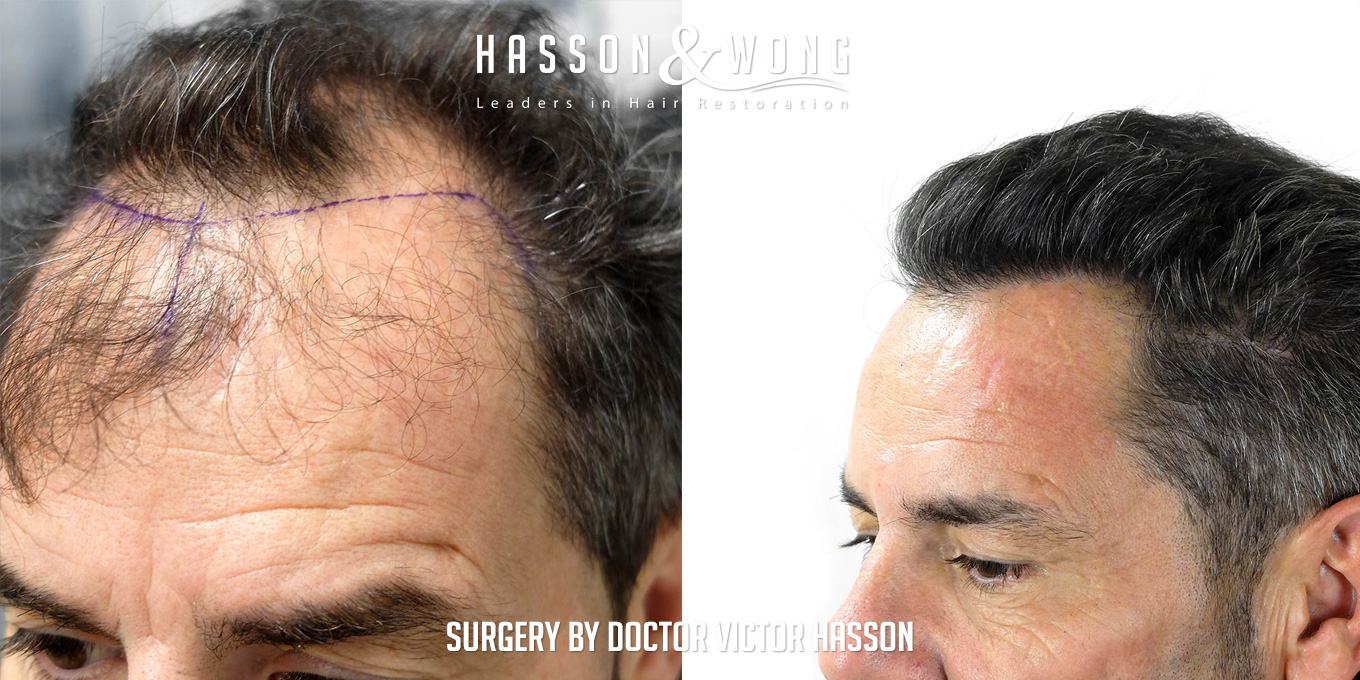 sl-drh-fut-hair-transplant-4656-grafts-left-close-before-after.jpg