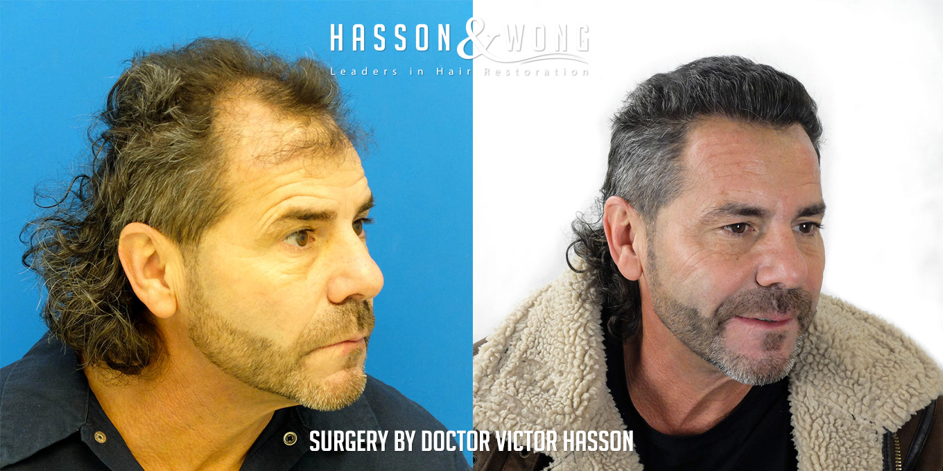 sl-drh-fut-hair-transplant-4656-grafts-right-before-after.jpg