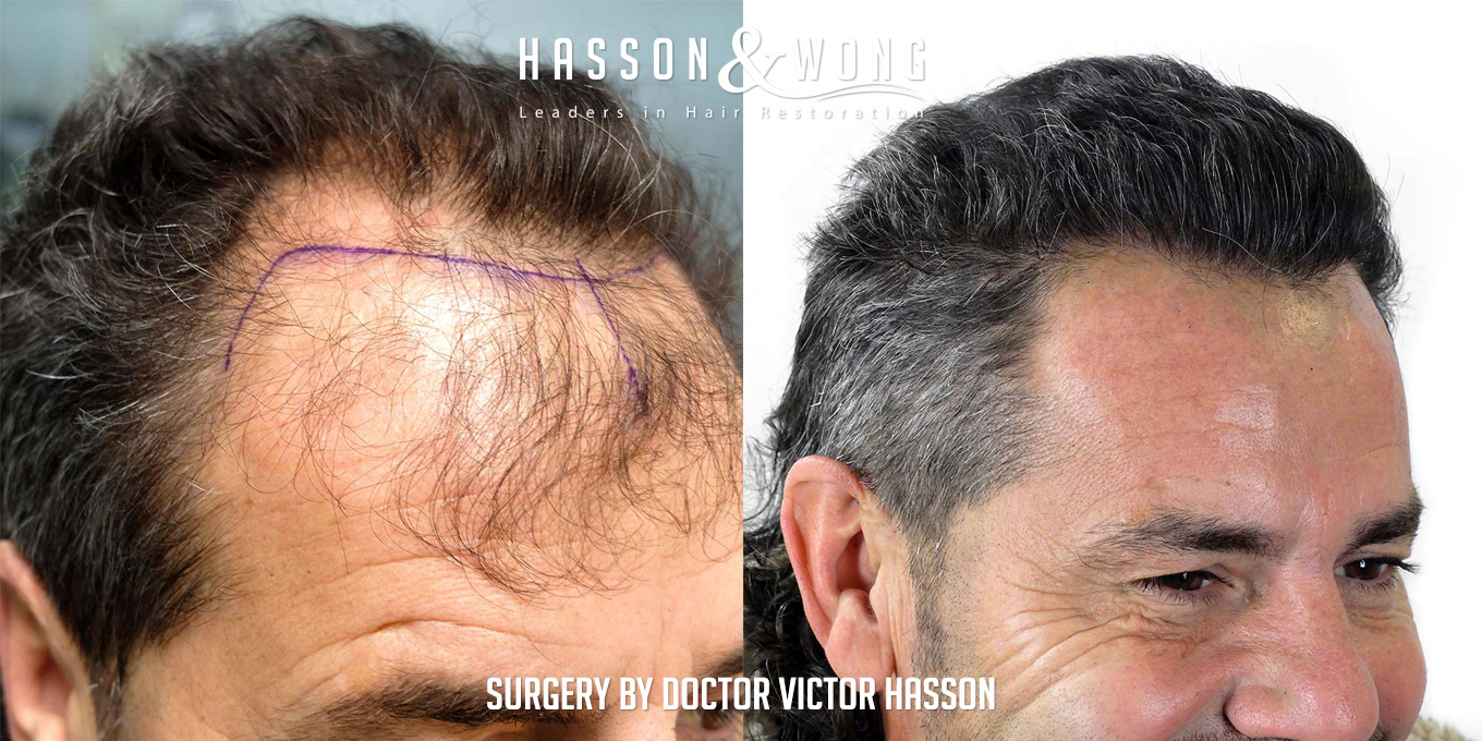 sl-drh-fut-hair-transplant-4656-grafts-right-close-before-after.jpg