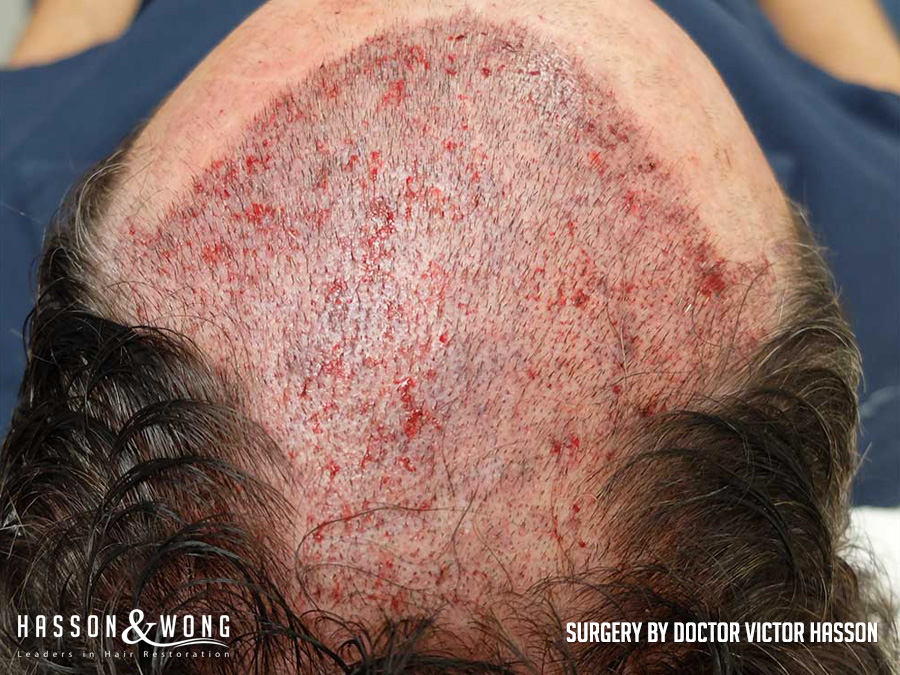 sl-drh-fut-hair-transplant-4656-grafts-surgery.jpg