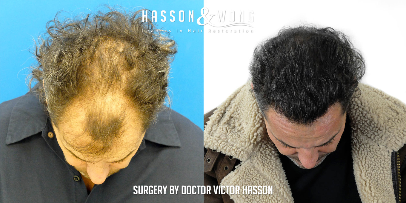 sl-drh-fut-hair-transplant-4656-grafts-top-before-after.jpg