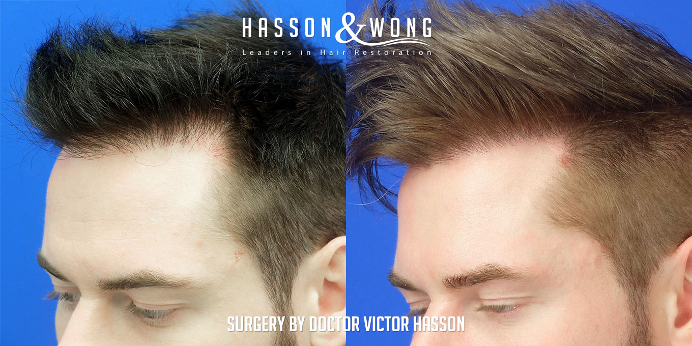 hair-restoration-surgery-before-after-20