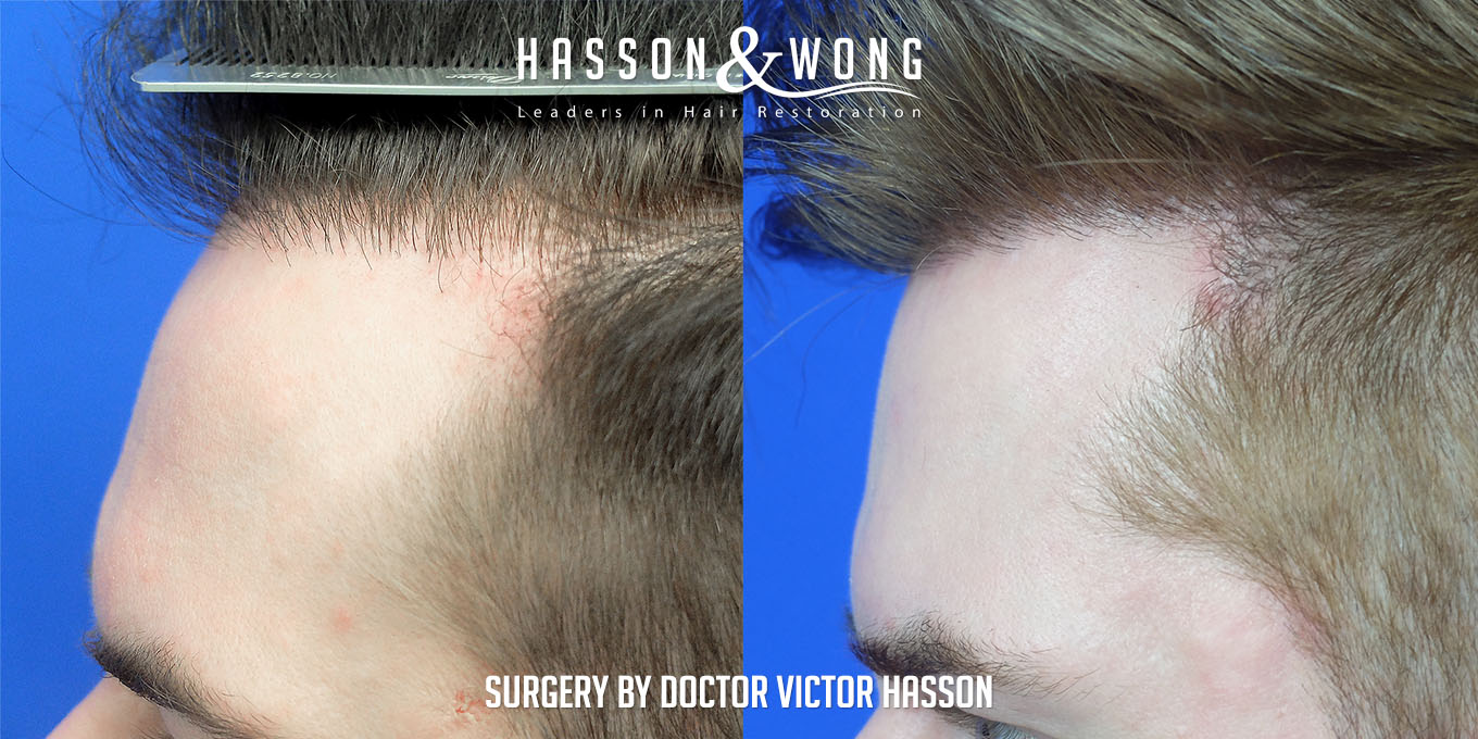hair-restoration-surgery-before-after-20