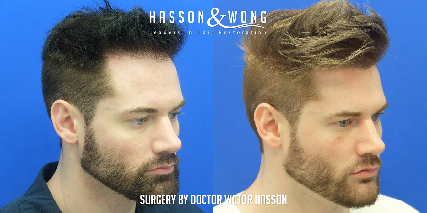 hair-transplant-surgery-before-after-200