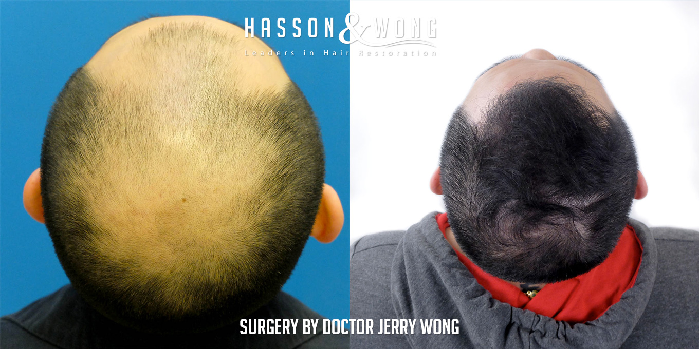 th-drw-fut-hair-transplant-6158-grafts-back-before-after.jpg