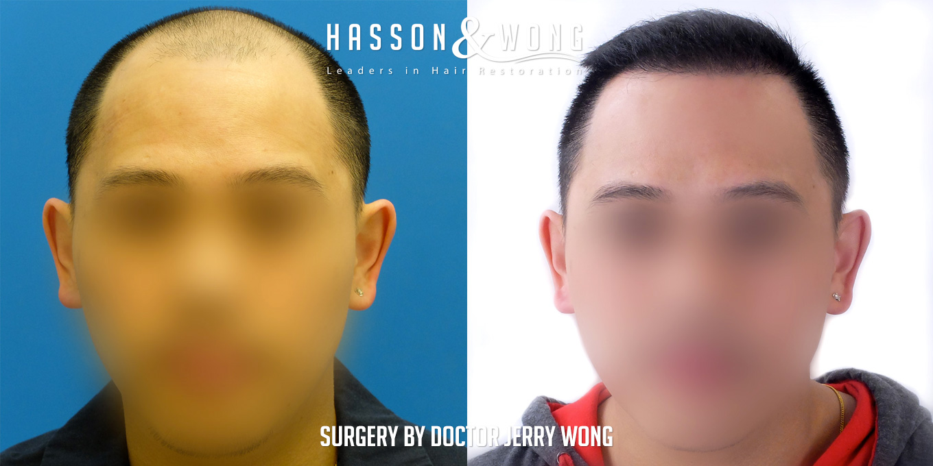 th-drw-fut-hair-transplant-6158-grafts-front-before-after.jpg