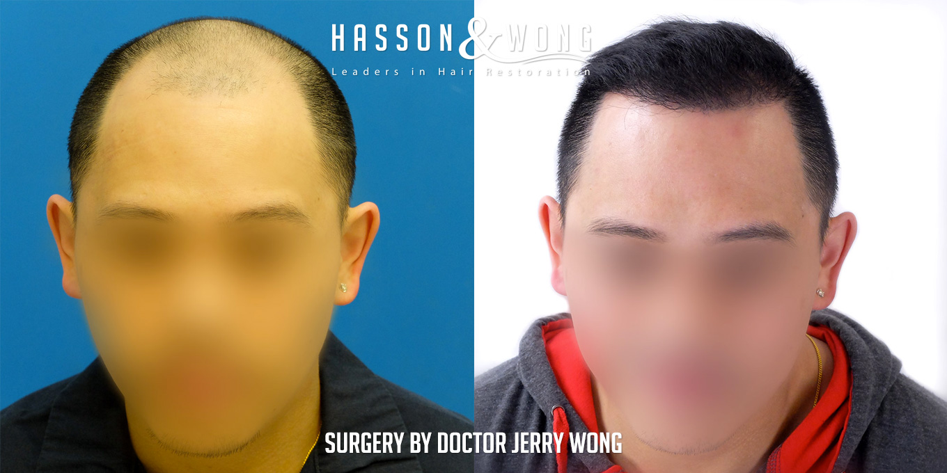 th-drw-fut-hair-transplant-6158-grafts-front-tilt-before-after.jpg