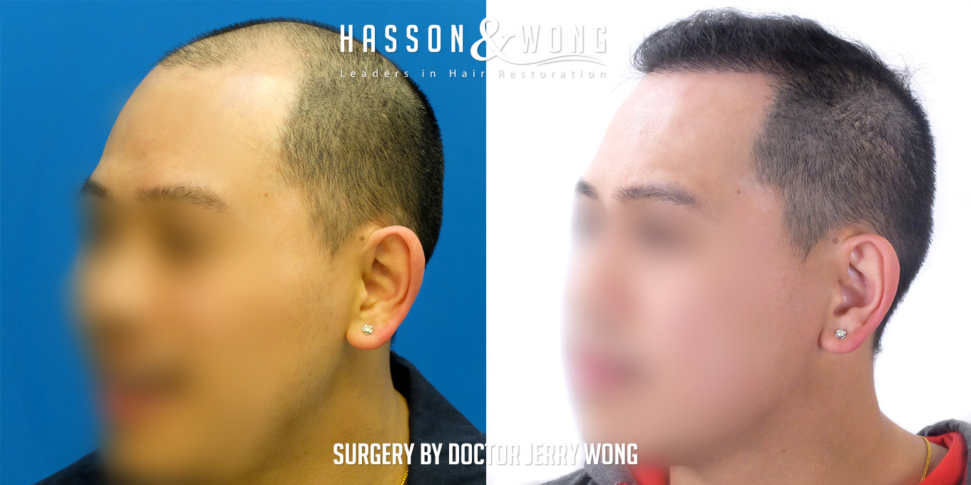 th-drw-fut-hair-transplant-6158-grafts-left-angle-before-after.jpg