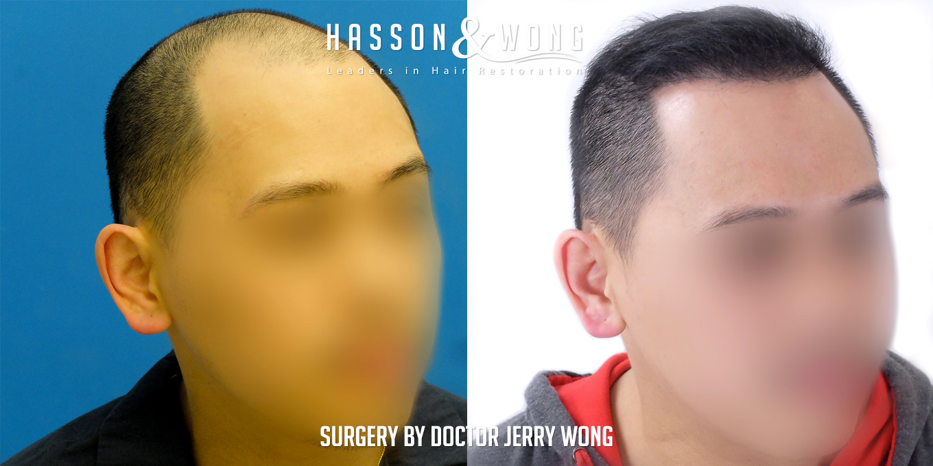 th-drw-fut-hair-transplant-6158-grafts-right-angle-before-after.jpg
