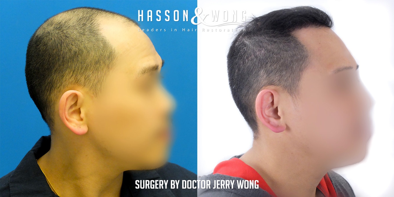 th-drw-fut-hair-transplant-6158-grafts-right-before-after.jpg