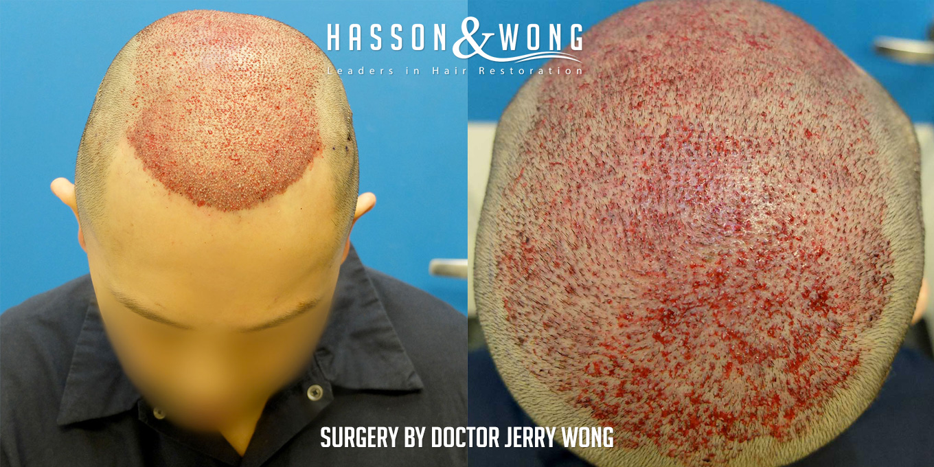 th-drw-fut-hair-transplant-6158-grafts-surgery.jpg