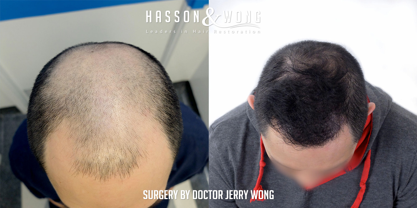th-drw-fut-hair-transplant-6158-grafts-top-before-after.jpg