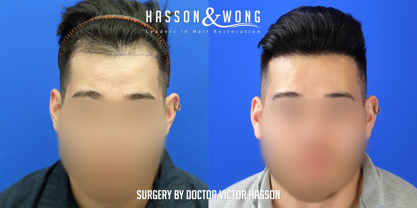 hair-restoration-surgery-before-after-34
