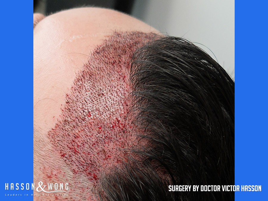 hair-restoration-surgery-before-after-34