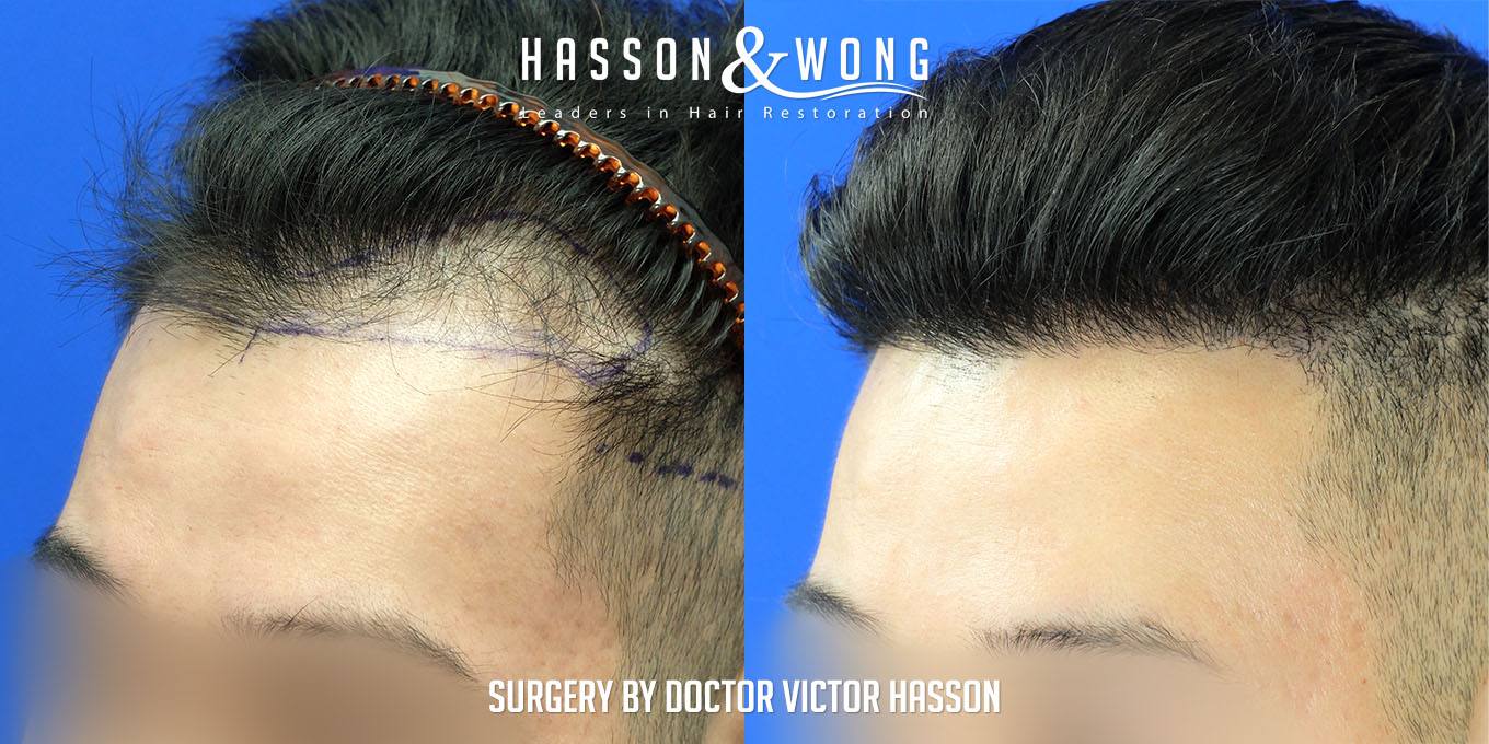 hair-transplant-surgery-before-after-346