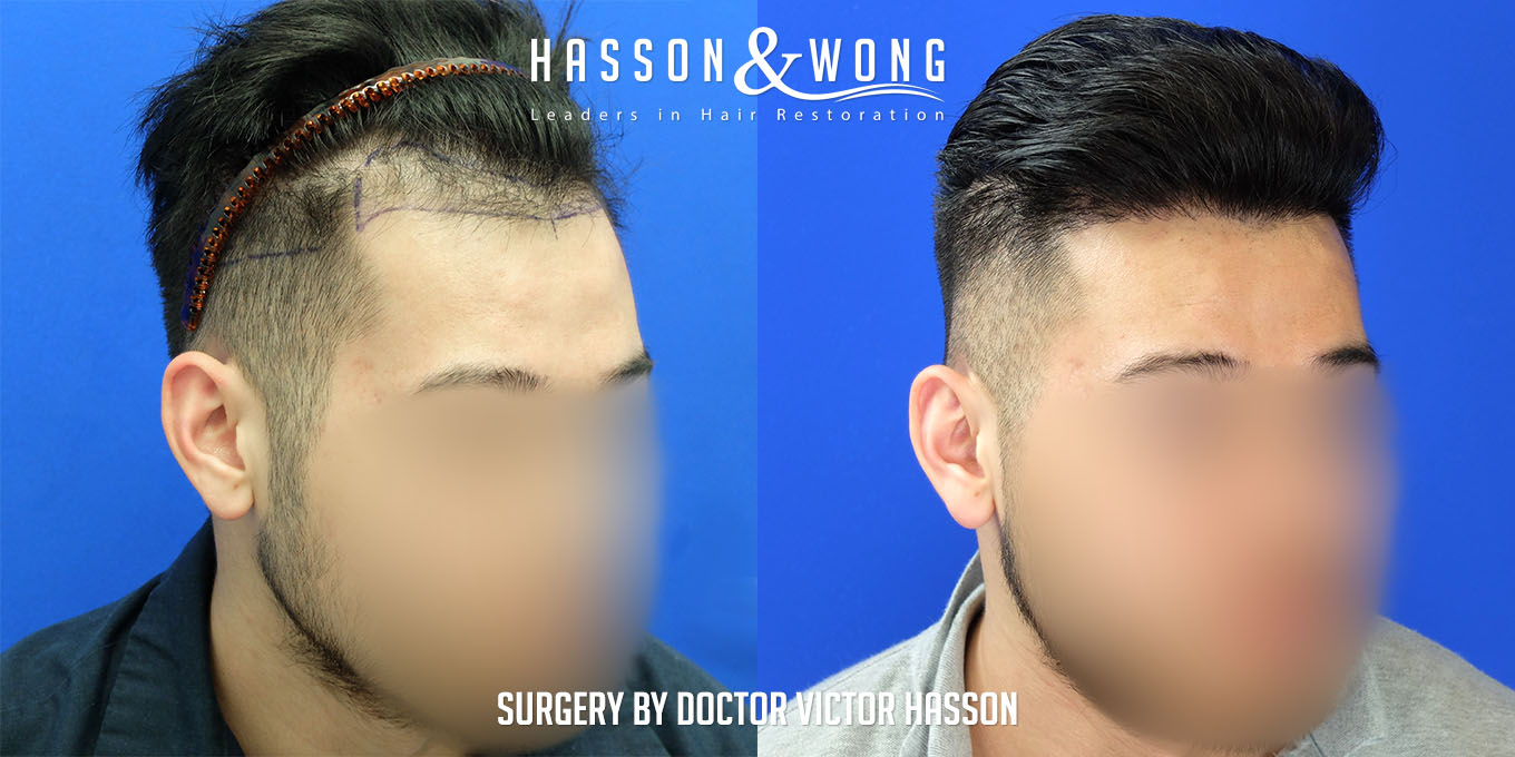 hair-transplant-surgery-before-after-346
