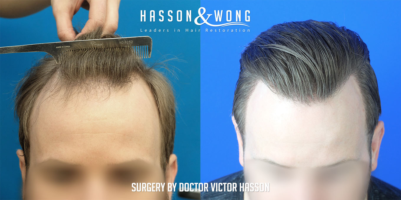 ts-drh-fue-hair-transplant-2640-grafts-front-close-before-after.jpg